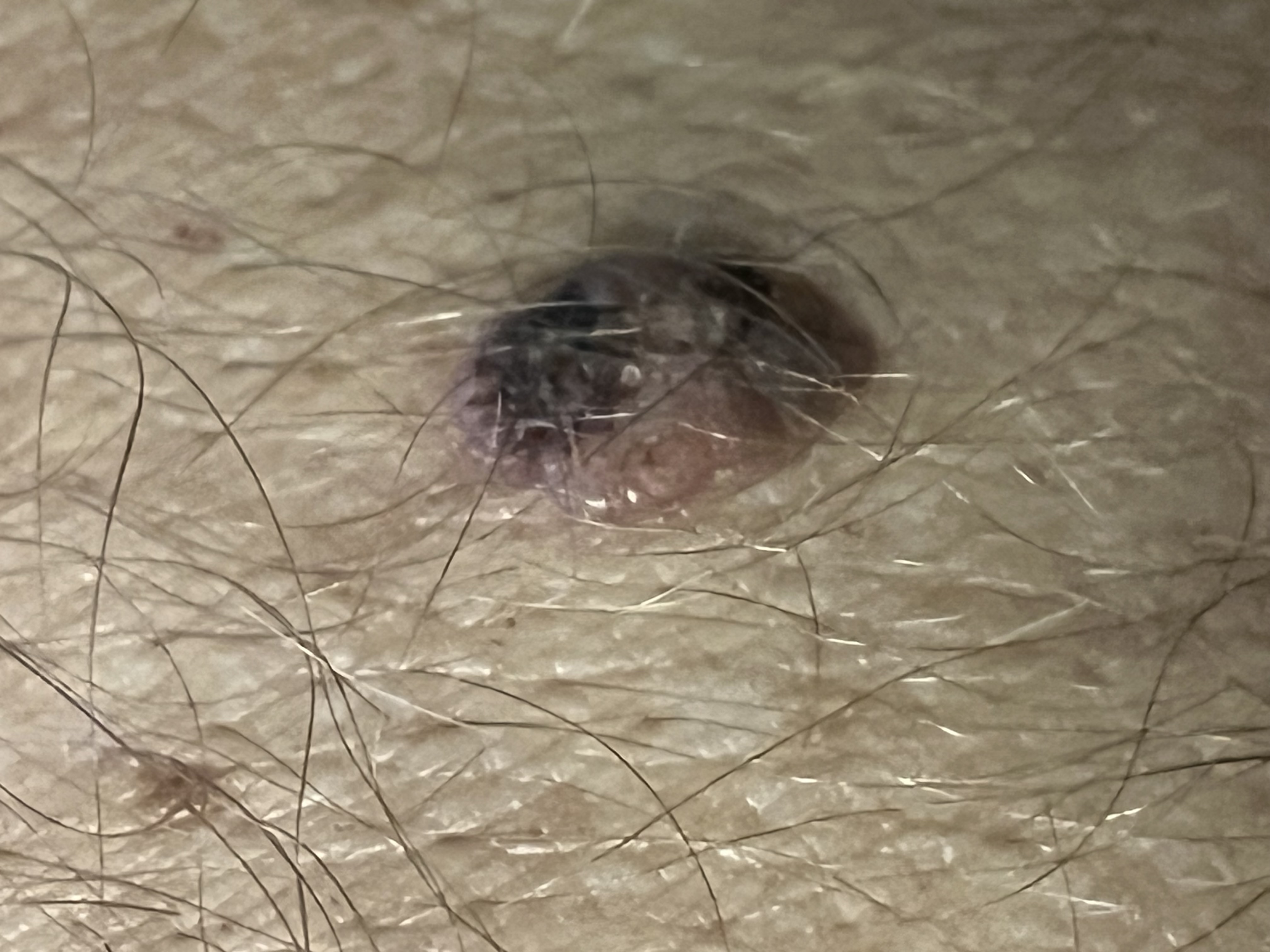 Znamínko obrázek 2