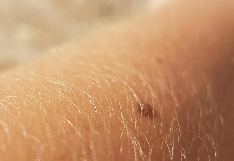 Piha na kůži, autor obrázku Fermi, zdroj Pixabay.com